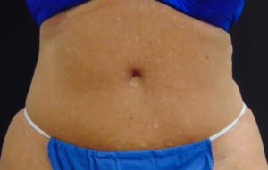 Tummy Tuck 1 After