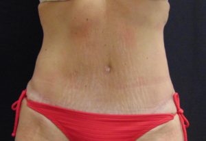 Tummy Tuck 2 After