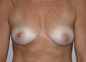 Breast Augmentation Before and After Pictures Jacksonville, FL