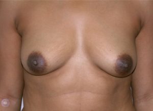 Breast Augmentation Before and After Pictures Jacksonville, FL