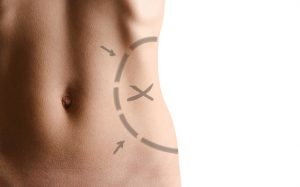 Liposuction in Jacksonville, FL